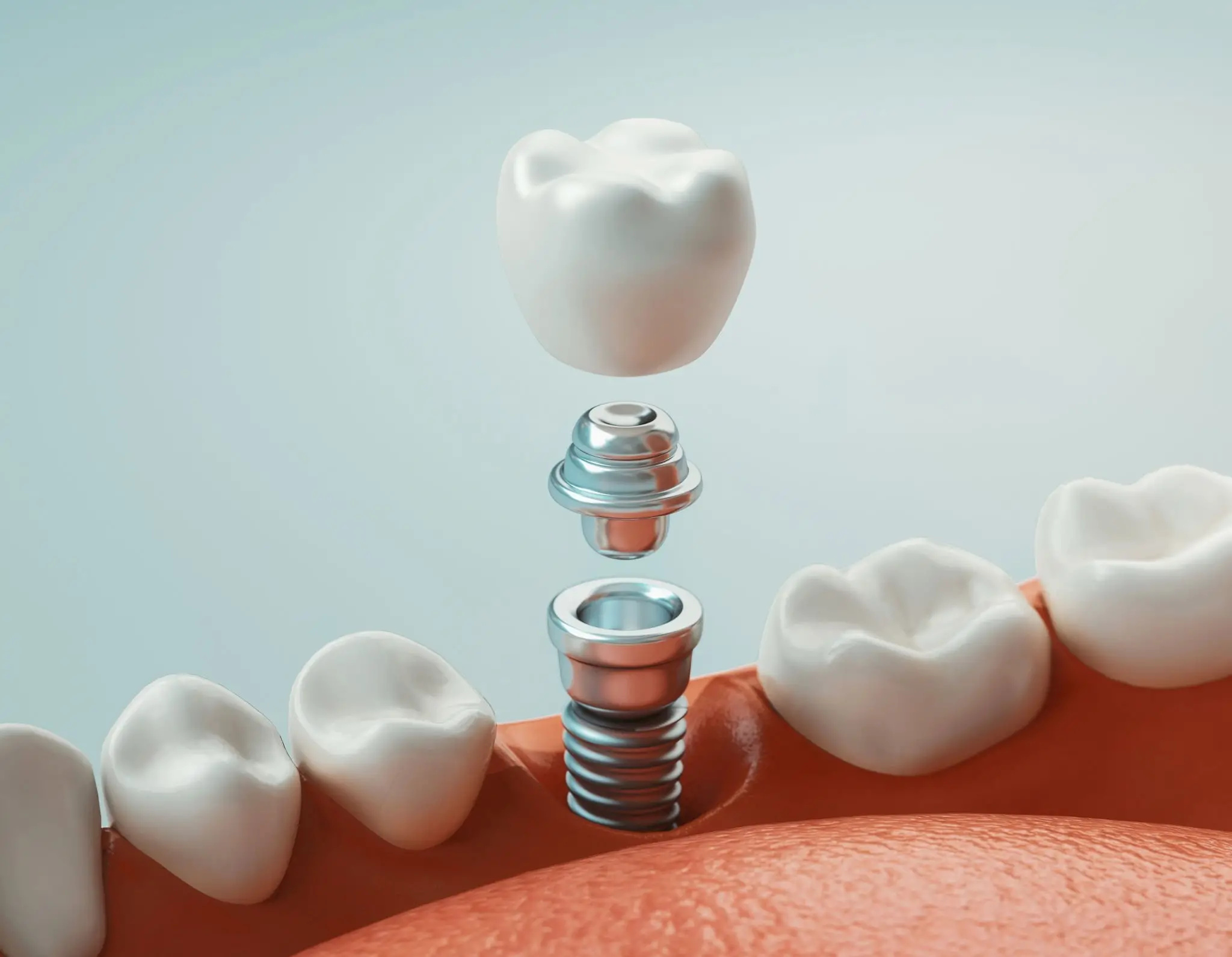 Dental Implant Dental Implant