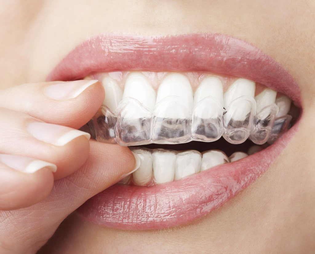 Invisalign Invisalign